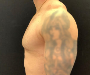 Gynecomastia