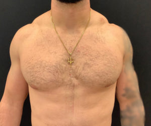 Gynecomastia