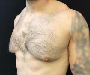 Gynecomastia