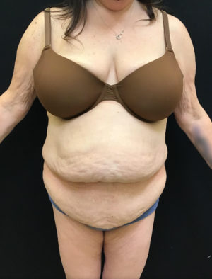 Tummy Tuck