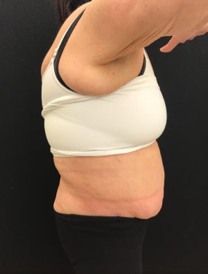 Tummy Tuck