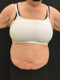 Tummy Tuck