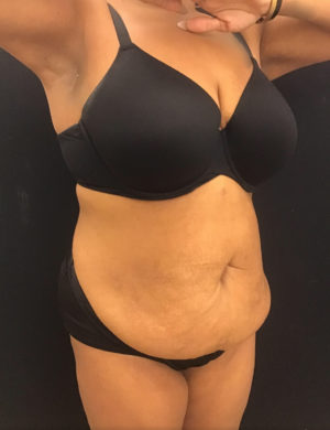 Liposuction