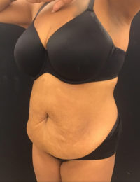 Liposuction