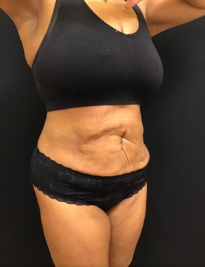 Liposuction