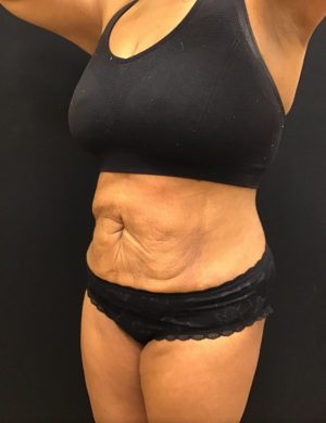 Liposuction