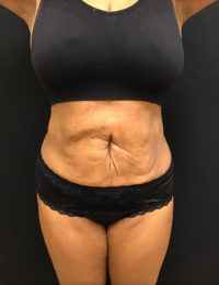 Liposuction