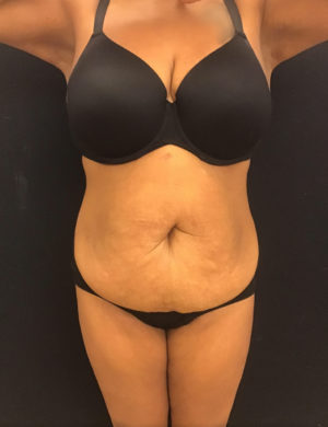 Liposuction