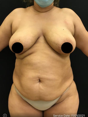 Breast Lift