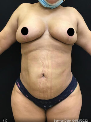 Breast Lift