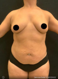 Breast Augmentation