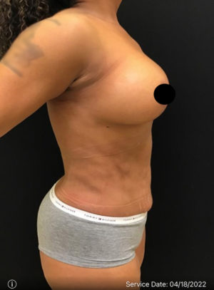 Breast Augmentation