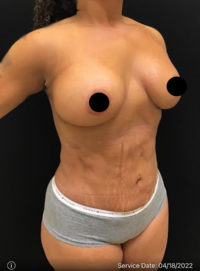 Breast Augmentation