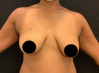 Breast Augmentation