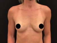 Breast Augmentation