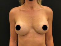 Breast Augmentation