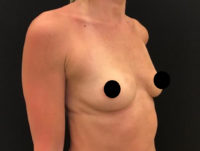 Breast Augmentation