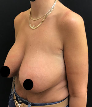 Breast Lift