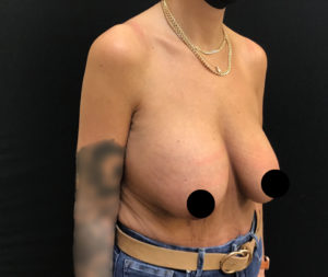 Breast Lift