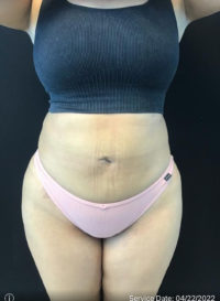 Liposuction