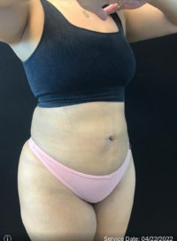 Liposuction