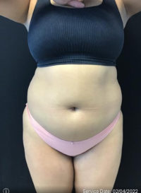 Liposuction