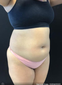 Liposuction