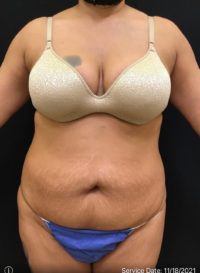 Liposuction