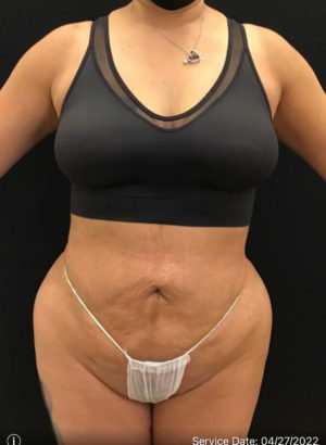 Liposuction