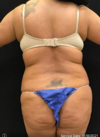 Liposuction