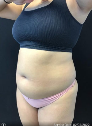 Tummy Tuck