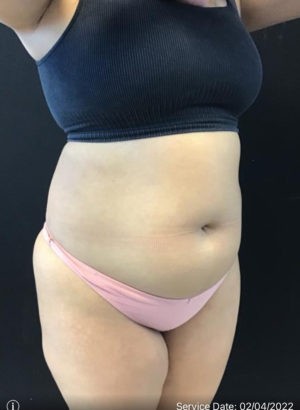 Tummy Tuck