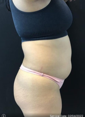 Tummy Tuck