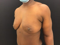 Breast Augmentation