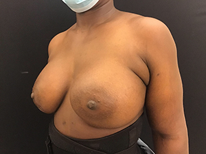 Breast Augmentation