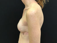 Breast Reconstruction