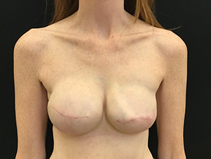 Breast Reconstruction