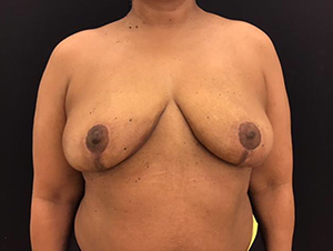 Breast Reduction