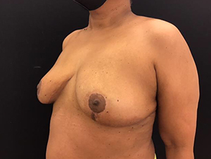 Breast Reduction