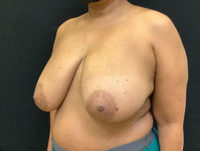 Breast Reduction