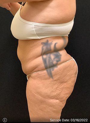 Liposuction