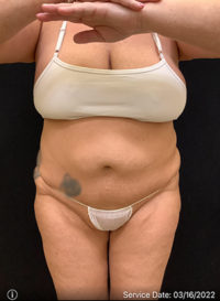 Liposuction