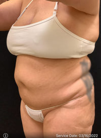 Liposuction