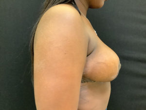 Breast Reduction