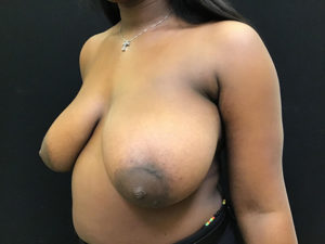 Breast Reduction