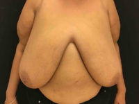 Breast Reduction