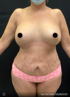 Breast Augmentation