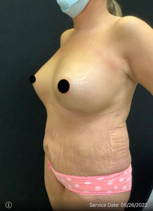 Breast Augmentation
