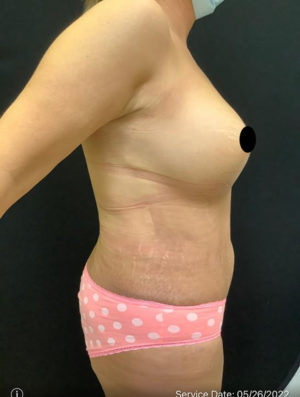 Breast Augmentation