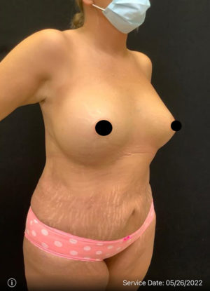 Breast Augmentation